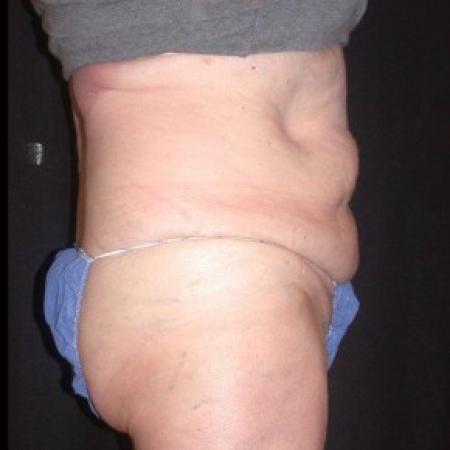 After image 3 Case #81861 - CoolSculpting