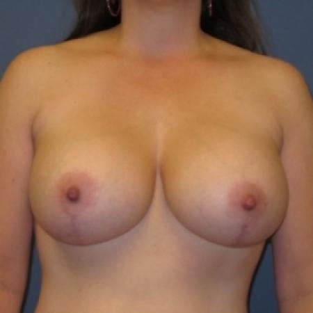 After image 1 Case #80716 - Breast Lift with Augmentation