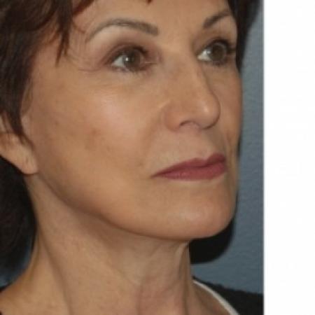After image 3 Case #81101 - Facelift