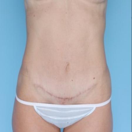 After image 1 Case #82206 - Mommy Makeover
