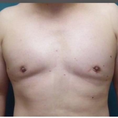 After image 1 Case #86676 - Gynecomastia Correction