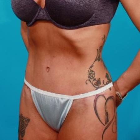 After image 2 Case #83936 - Athletic Tummy Tuck