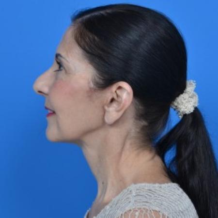 After image 5 Case #88061 - Facelift and Neck Lift