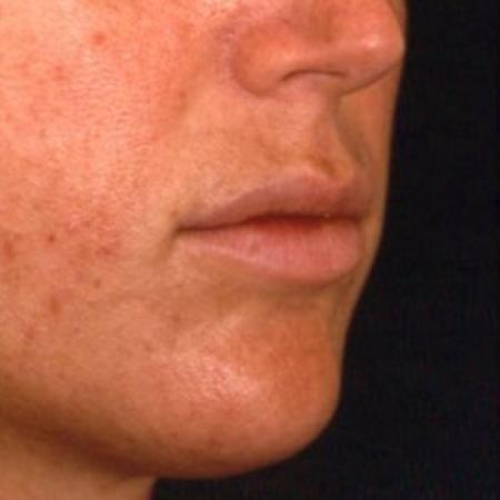 After Case #81641 - Lip Augmentation