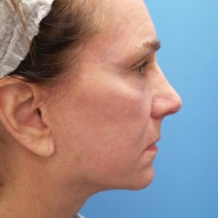 After image 3 Case #86636 - Facelift/Rhinoplasty/Laser Resurfacing to Full Face