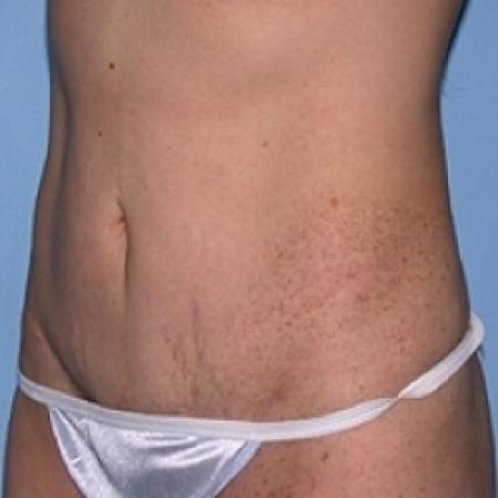 After image 3 Case #79156 - Tummy Tuck