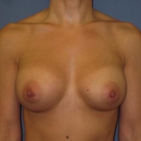 After image 1 Case #80696 - Breast Augmentation