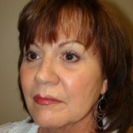 After image 2 Case #79621 - Blepharoplasty