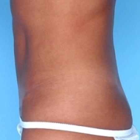 After image 2 Case #79166 - Tummy Tuck