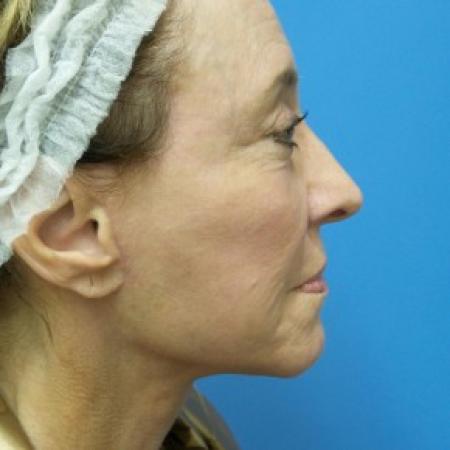 After image 3 Case #87181 - 68 year old  -  Facelift  -  3 months post-op