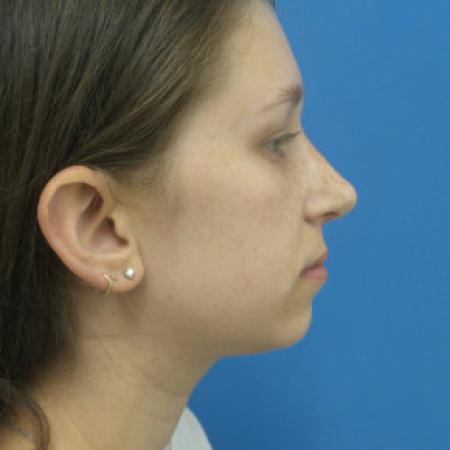 After image 3 Case #88391 - 25 year old  -  Rhinoplasty/Septoplasty/Partial Turbinectomy  -  7 months post-op