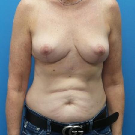 After image 1 Case #86466 - Bilateral Breast Reduction