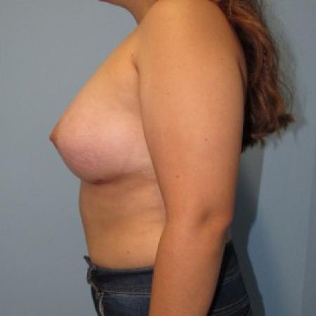 After image 2 Case #87201 - Breast Augmentation in 25 year-old