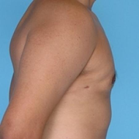 After image 2 Case #79236 - Male Breast Reduction