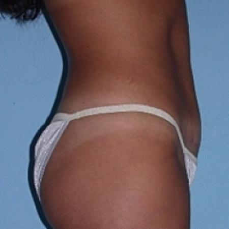 After image 2 Case #79151 - Tummy Tuck