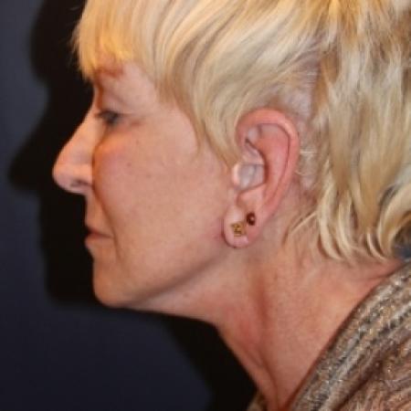 After image 2 Case #80471 - Face Lift