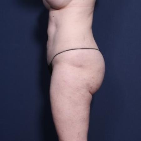 After image 2 Case #83566 - 43 Years Old Female