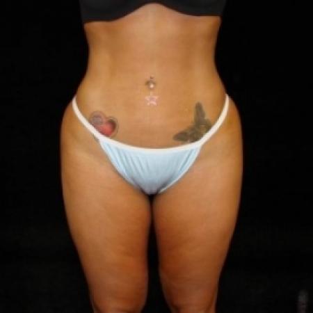 After image 1 Case #80481 - Buttocks Augmentation Via Fat Grafting with Lipsuction of Abdomen, Waist, Flanks, and Outer Thighs