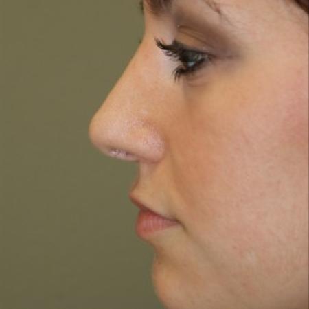 After image 2 Case #81876 - Rhinoplasty