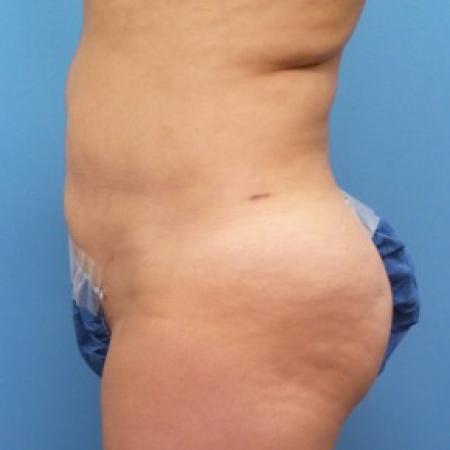 After image 2 Case #86656 - Liposuction of Abdomen, Waist & Flanks - 3 months post-op