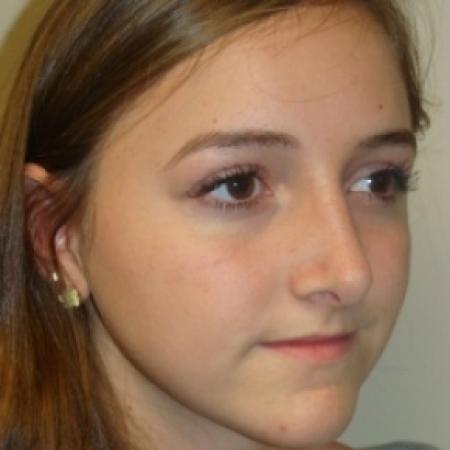 After image 4 Case #80406 - Open Rhinoplasty