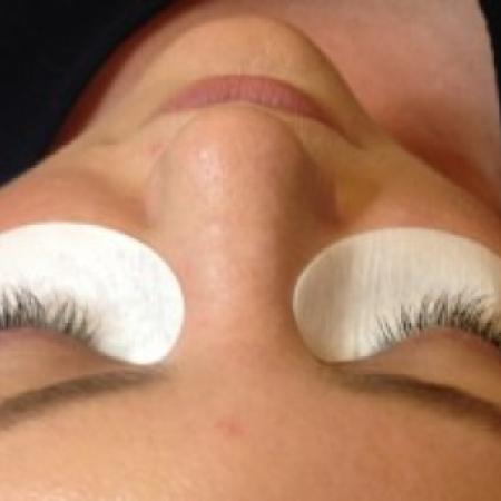 After Case #86381 - 35 year old woman treated with eyelash enhancement