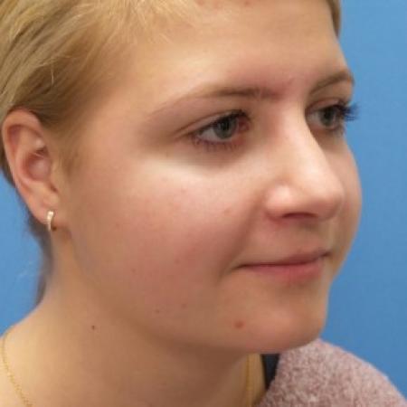 After image 2 Case #87221 - 18 year old - Rhinoplasty/Septoplasty/Turbinectomy  -  5 months post-op