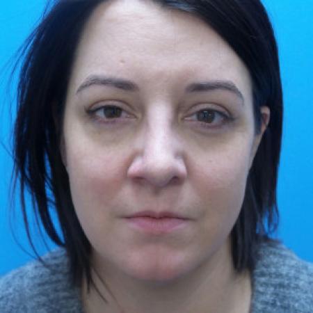 After image 1 Case #88206 - 40 year old  -  Rhinoplasty & Septoplasty  -  1 month post-op