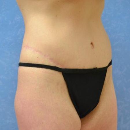 After image 1 Case #81386 - Circumferential body lift with medial thighplasty