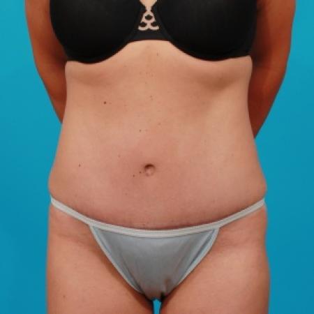 After image 1 Case #80741 - Tummy Tuck