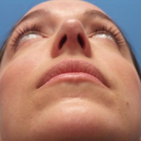 After image 4 Case #87411 - 31 year-old  -  Open Rhinoplasty/Endoscopic Browlift  -  3 months post-op