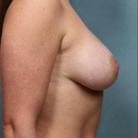 After image 3 Case #86786 - Breast Augmentation 