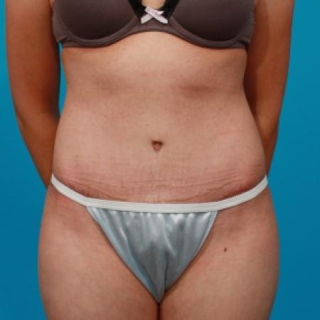 After image 1 Case #79296 - Tummy Tuck