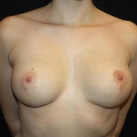 After image 1 Case #85851 - Breast Lift with Reduction - 23 year old female