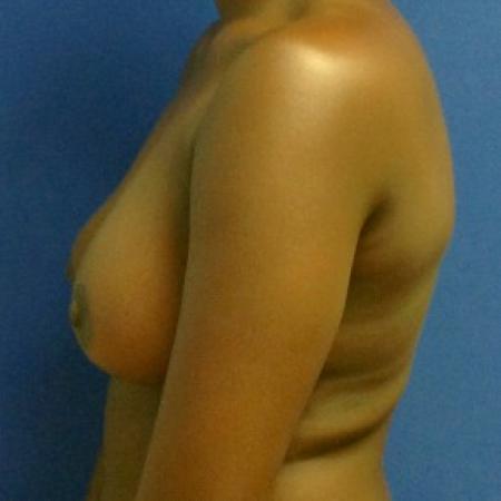 After image 3 Case #87226 - Wise Pattern Breast Reduction