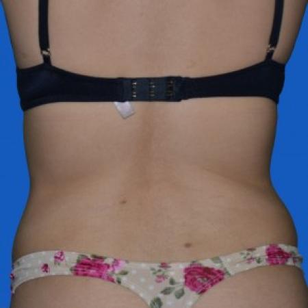 After image 3 Case #87851 - Tummy Tuck