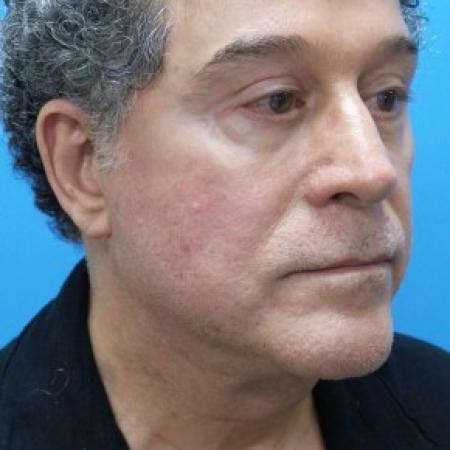 After image 2 Case #86716 - Facelift/Upper Blepharoplasty/Browlift - 1 year post-op