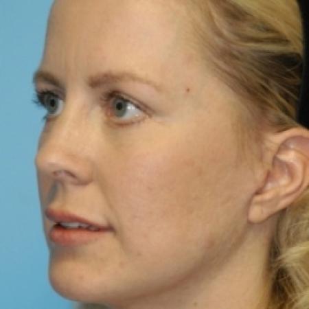After image 2 Case #79676 - Lip Grafting