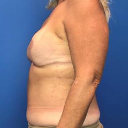 After image 2 Case #88421 - Breast reconstruction on a 59 year old female