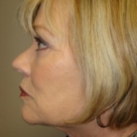 After image 4 Case #79056 - Facelift