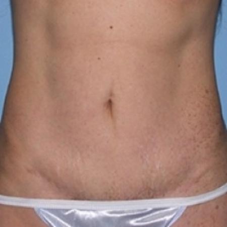 After image 1 Case #79156 - Tummy Tuck