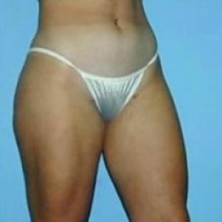 After image 2 Case #79176 - Liposuction