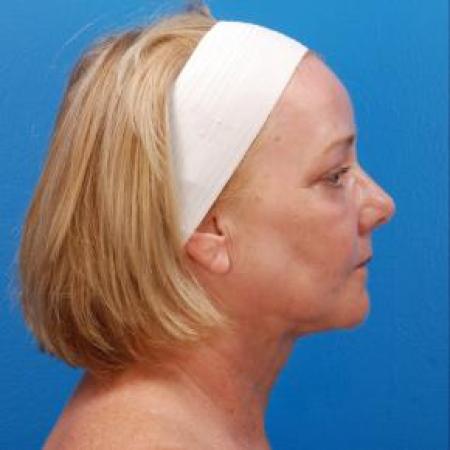 After image 2 Case #85331 - 61 y/o woman after Laser Liposuction to the neck, skin tightening, eyelid surgery, & fat grafting to the face