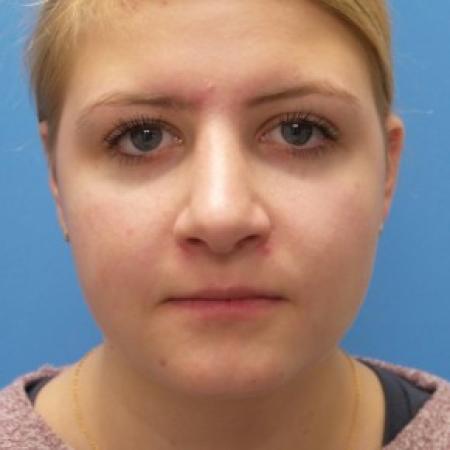 After image 1 Case #87221 - 18 year old - Rhinoplasty/Septoplasty/Turbinectomy  -  5 months post-op