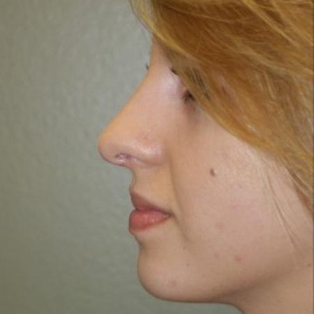 After image 2 Case #81881 - Open Structure Septorhinoplasty