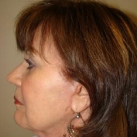 After image 5 Case #79616 - Facelift