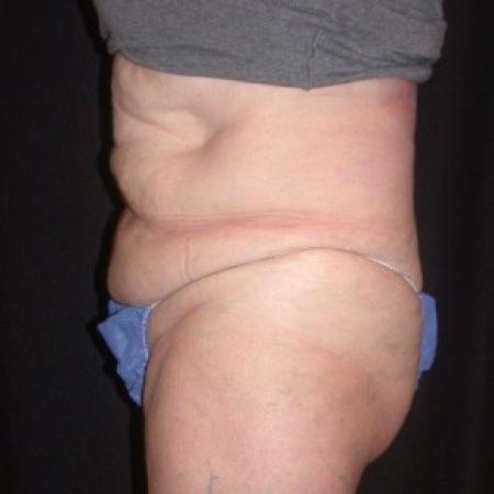 After image 4 Case #81861 - CoolSculpting