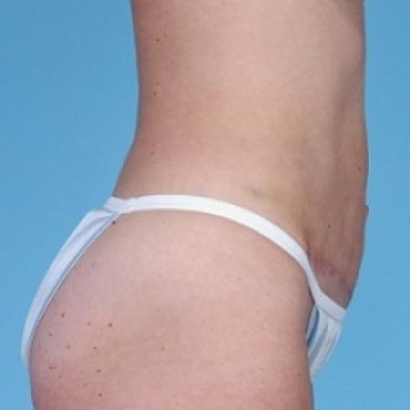 After image 2 Case #79161 - Tummy Tuck