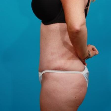 After image 3 Case #84101 - Abdominoplasty with Flank Lipo