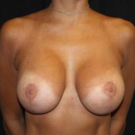 After image 1 Case #85036 - Breast lift with breast implants - 28 year old female